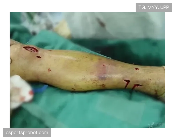 朗斯后卫乔纳森·格拉迪特胫骨腓骨骨折，术后进入恢复阶段